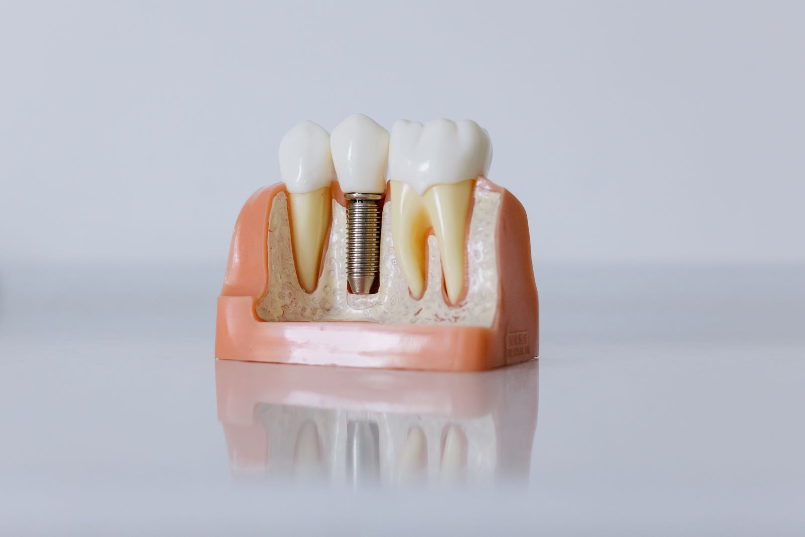 Model of a dental implant replacing a missing tooth