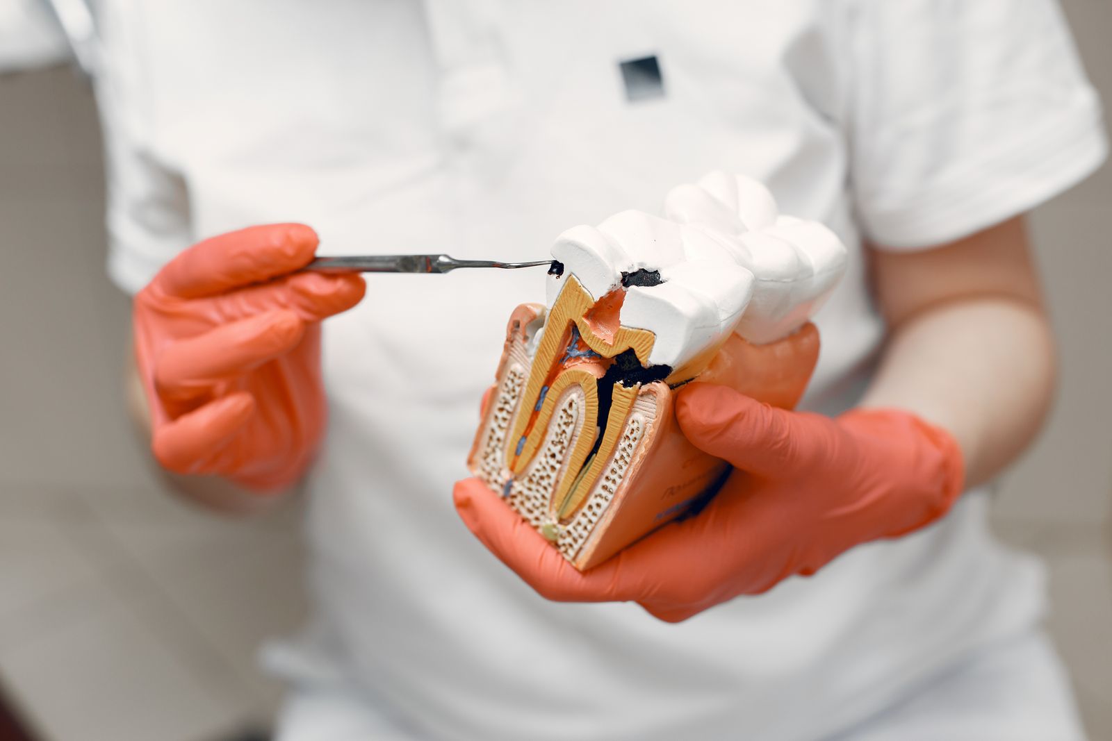Dentist holding a model of a tooth being filled